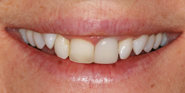 Before Image: Case 93 - front