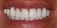 After Image: Case 94 - front