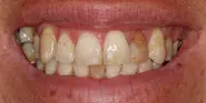 Before Image: Case 94 - front