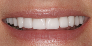 After Image: Case 96 - front