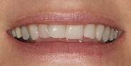 Before Image: Case 96 - front