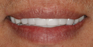 After Image: Case 97 - front