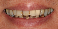 Before Image: Case 97 - front