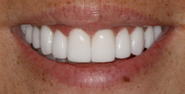 After Image: Case 98 - front