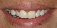 Before Image: Case 98 - front