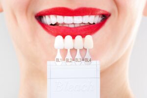 Close-up of a woman smiling and having her teeth color-matched for her porcelain veneers