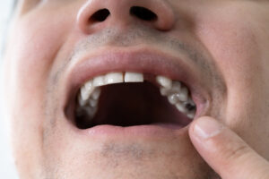 Close up of a man missing a tooth and in need of treatment before he experiences permanent oral damage