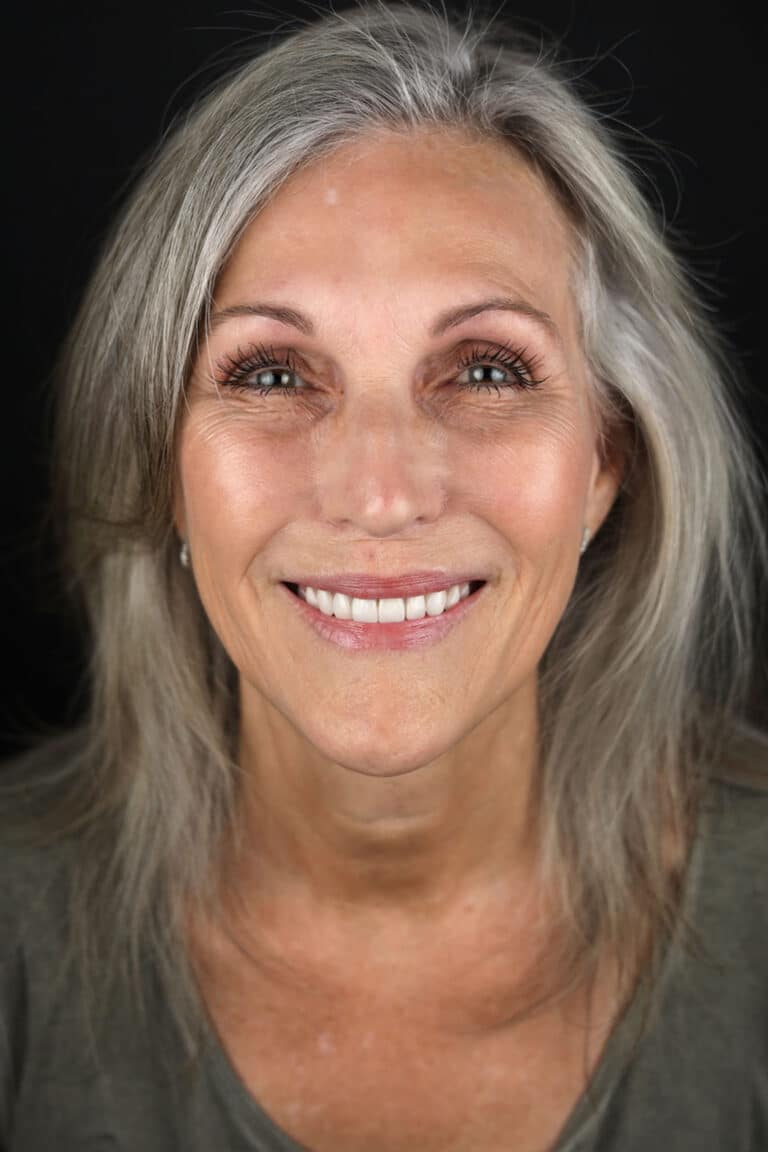 After Image: Case 492 - front