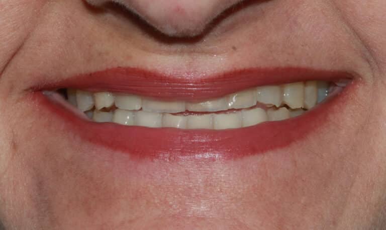 Before Image: Case 493 - front