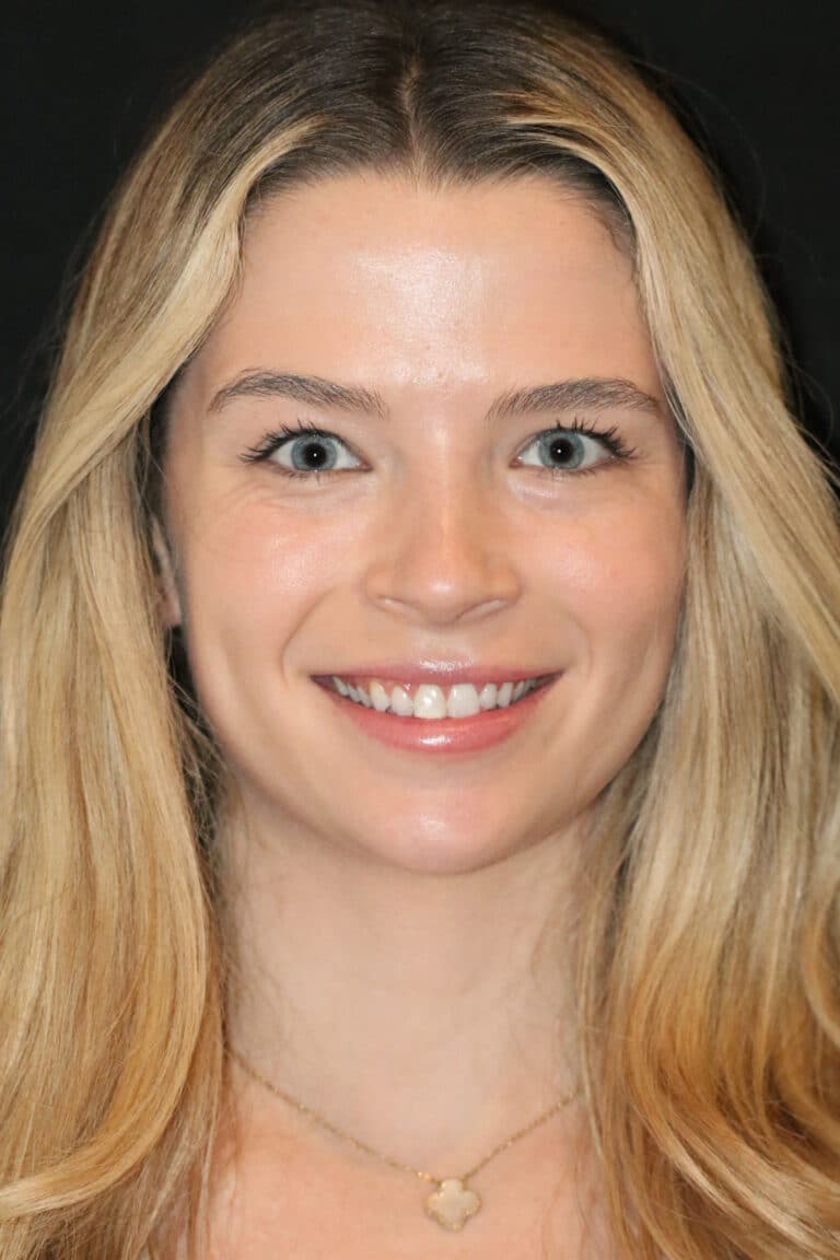 Before Image: Case 495 - front